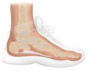 The Consequences of Leaving Plantar Fasciitis Untreated - Plantar