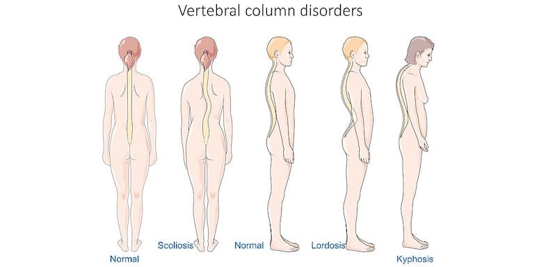 Scoliosis Regen Doctors