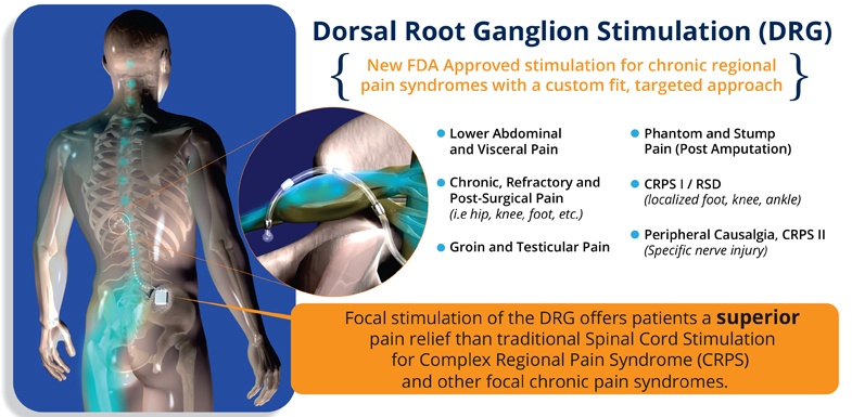 dorsal column stimulator for shingles pain