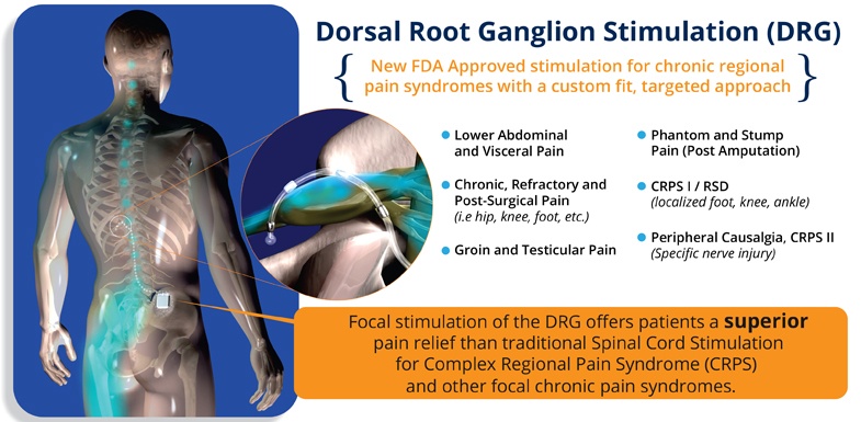 tens placement for dorsal column stimulation