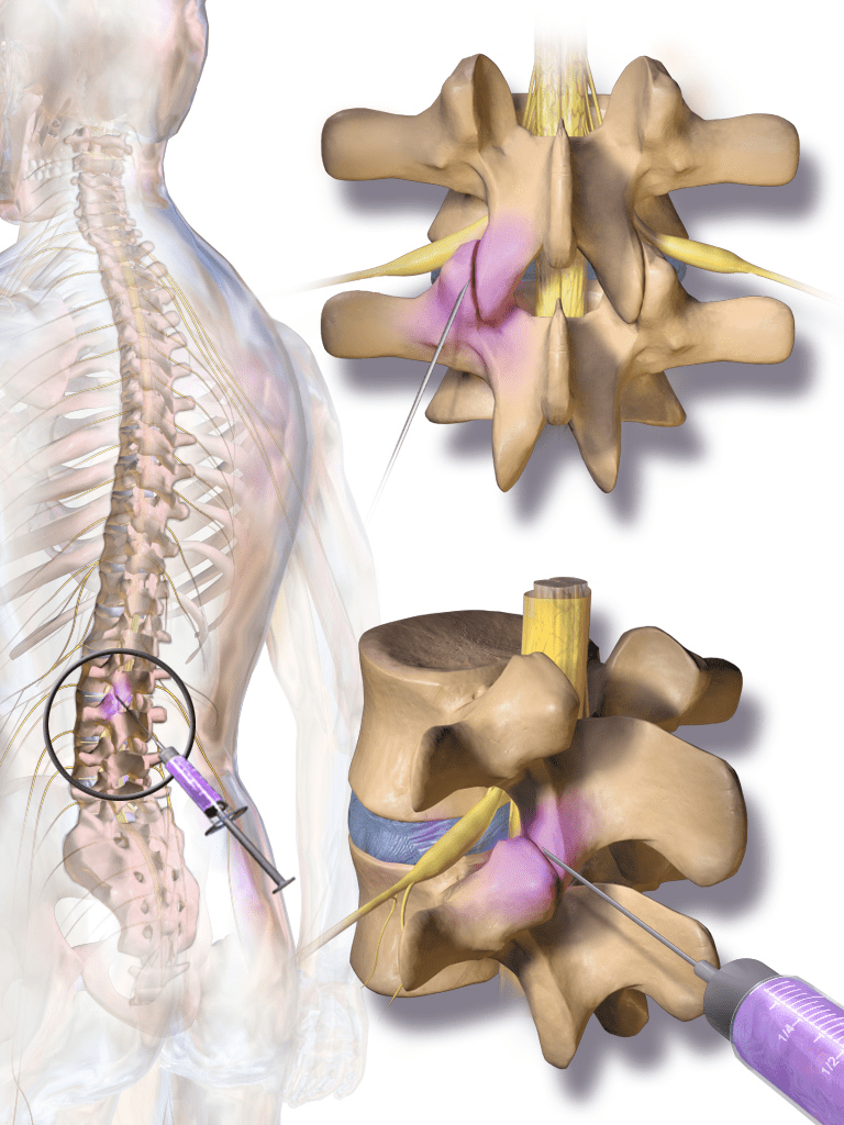 Facet Injections Illustration