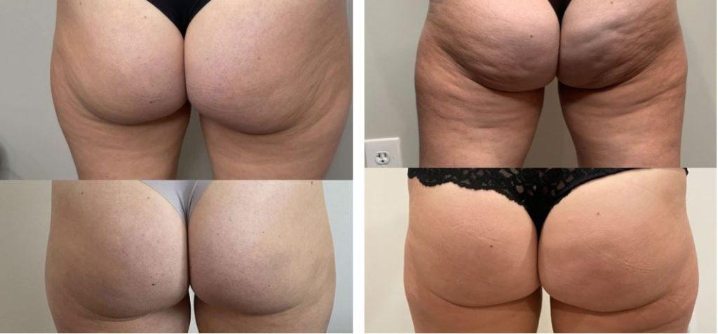 Booty Ready for Summer With QWO® Cellulite Treatment!